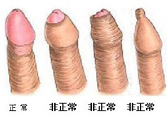 包皮过长是什么样子的