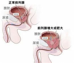 男性患上前列腺增生会呈现哪些不适病症
