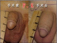 男人阴茎能够增长增粗吗阳江专家解答